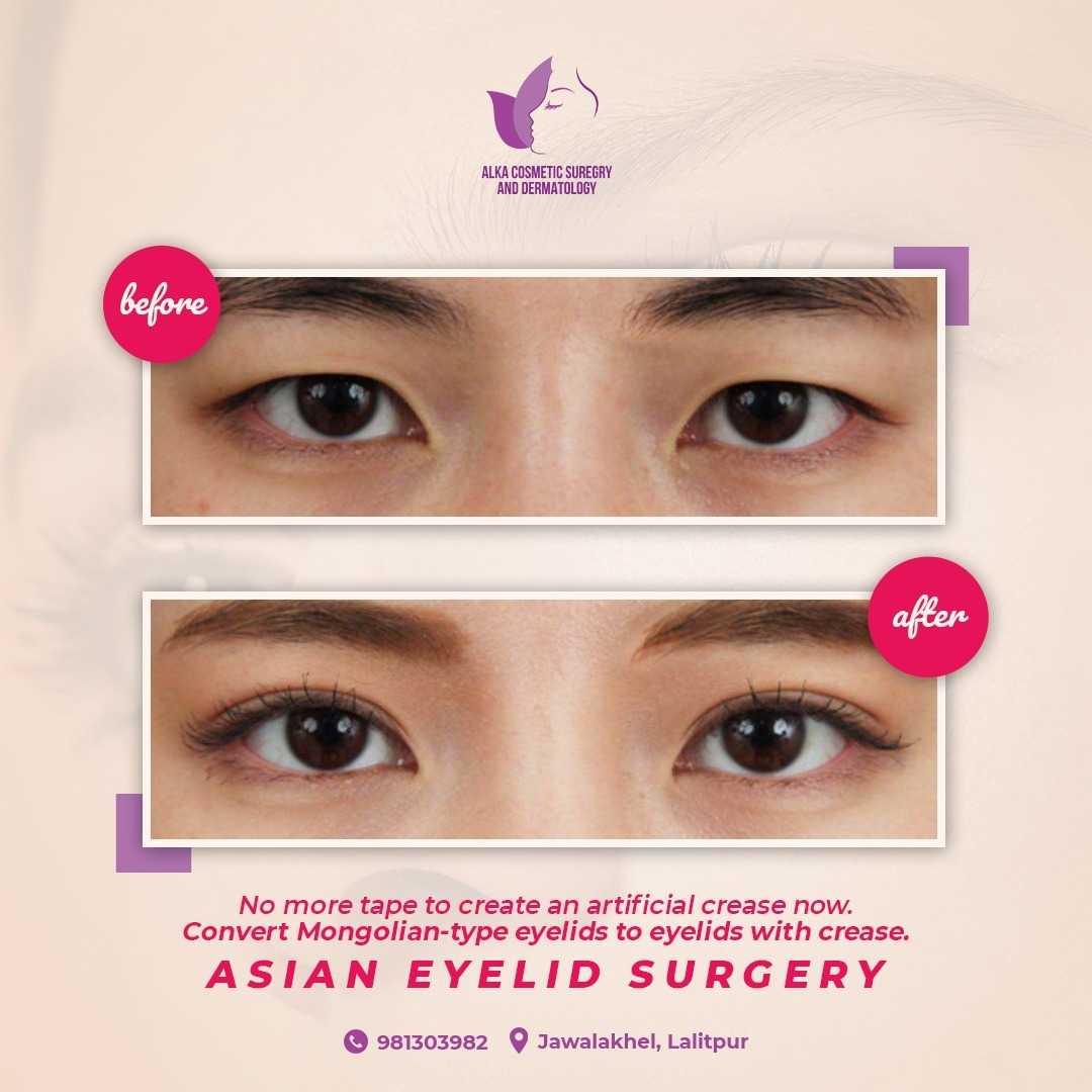 Eyelid Surgery Price In Nepal